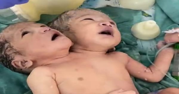 αñçαñéαñªαÑîαñ░ αñòαÑç αñàαñ╕αÑìαñ¬αññαñ╛αñ▓ αñ«αÑçαñé αñ¬αÑêαñªαñ╛ αñ╣αÑüαñå αñªαÑïαñ╕αñ░ αñ╡αñ╛αñ▓αñ╛ αñ¼αñÜαÑìαñÜαñ╛ ,αñ╡αñ£αñ¿ 2.82 αñòαñ┐αñ▓αÑï